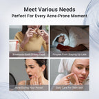 Acne Drying Lotion