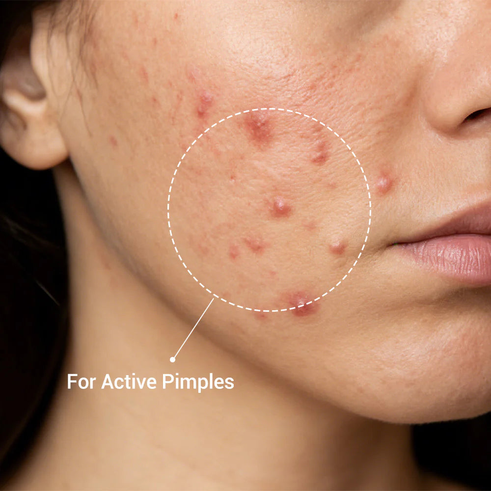 Acne Drying Lotion