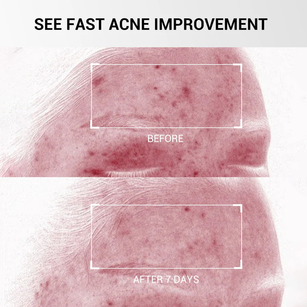 Acne Drying Lotion