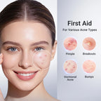 Acne Drying Lotion