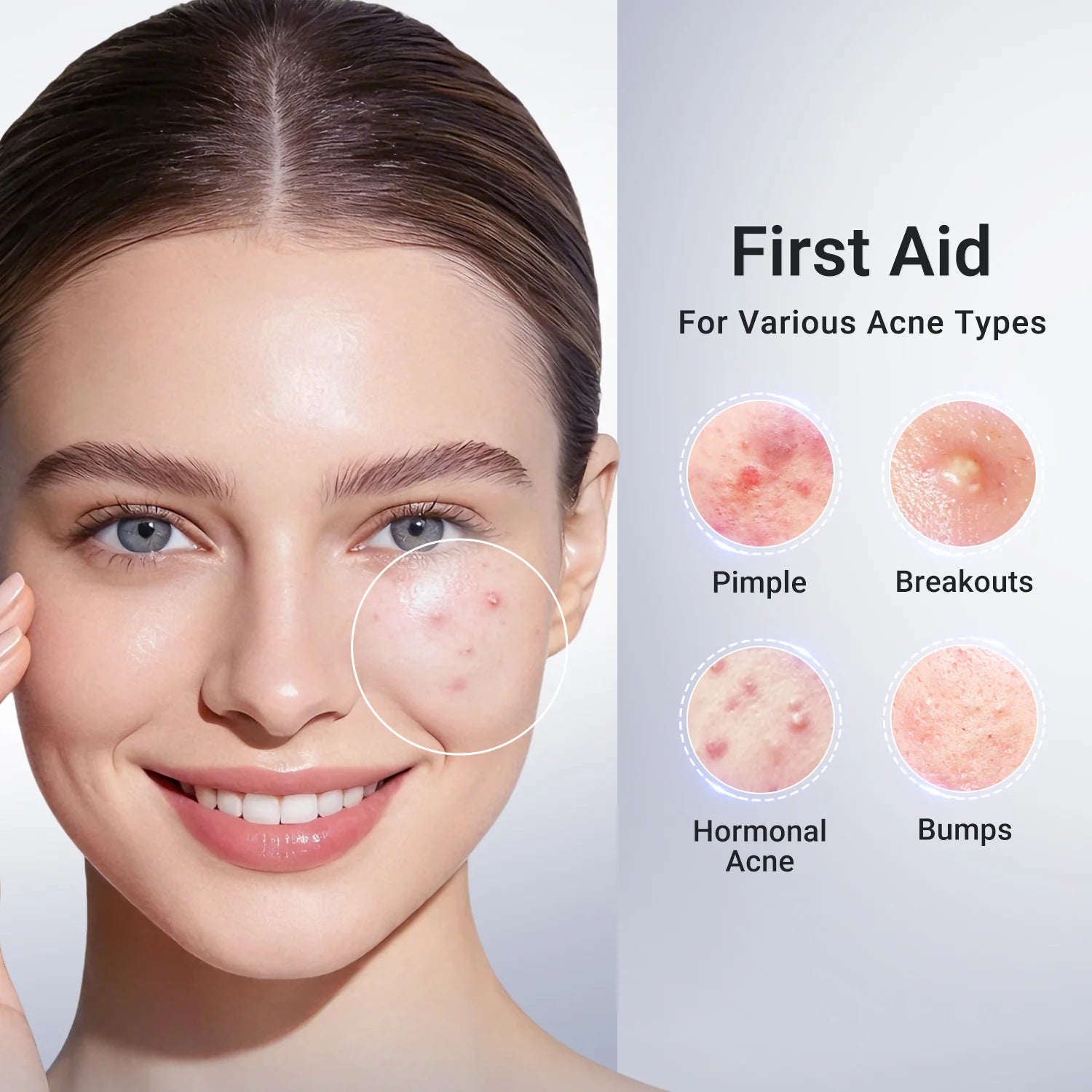 Acne Drying Lotion