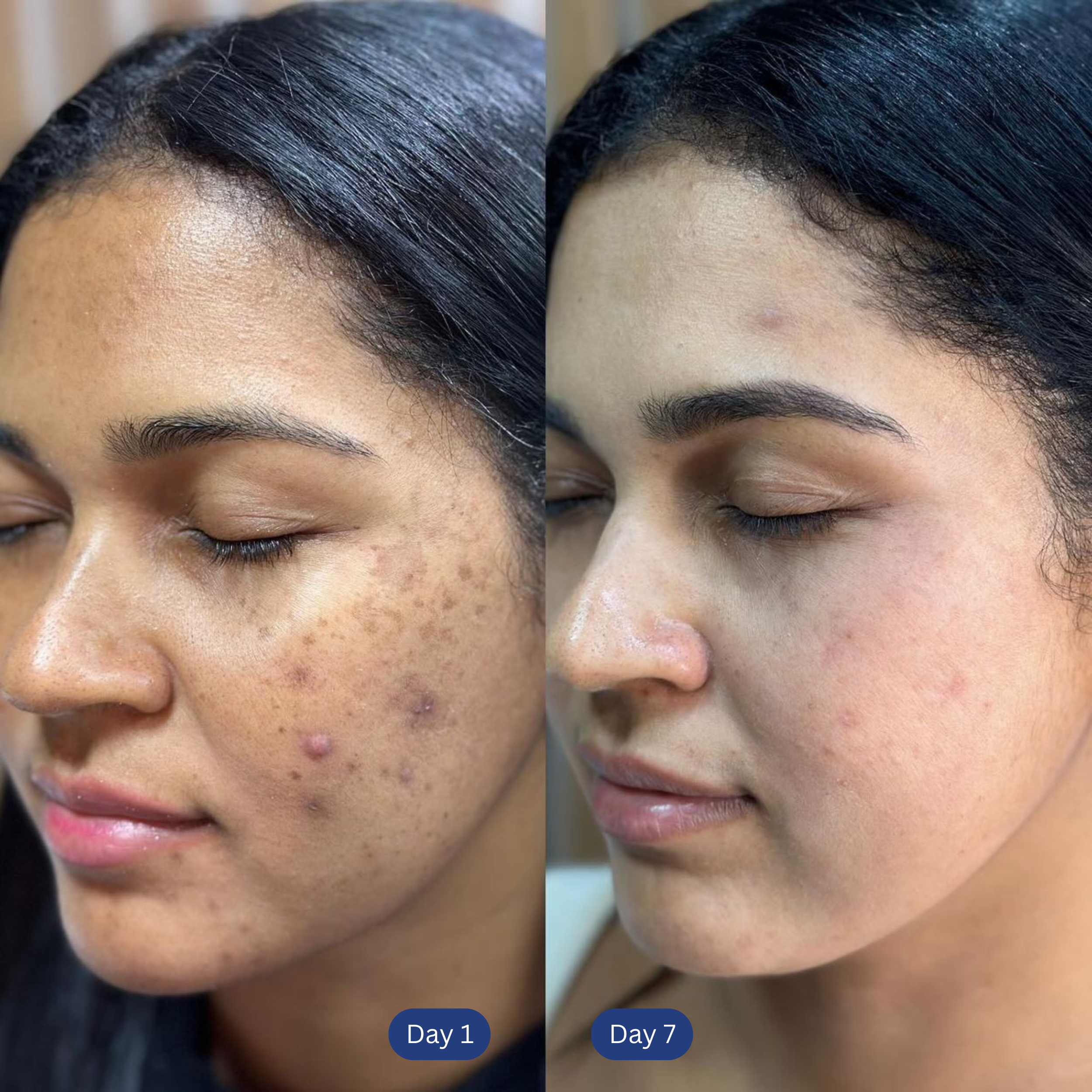 Acne Drying Lotion Plus